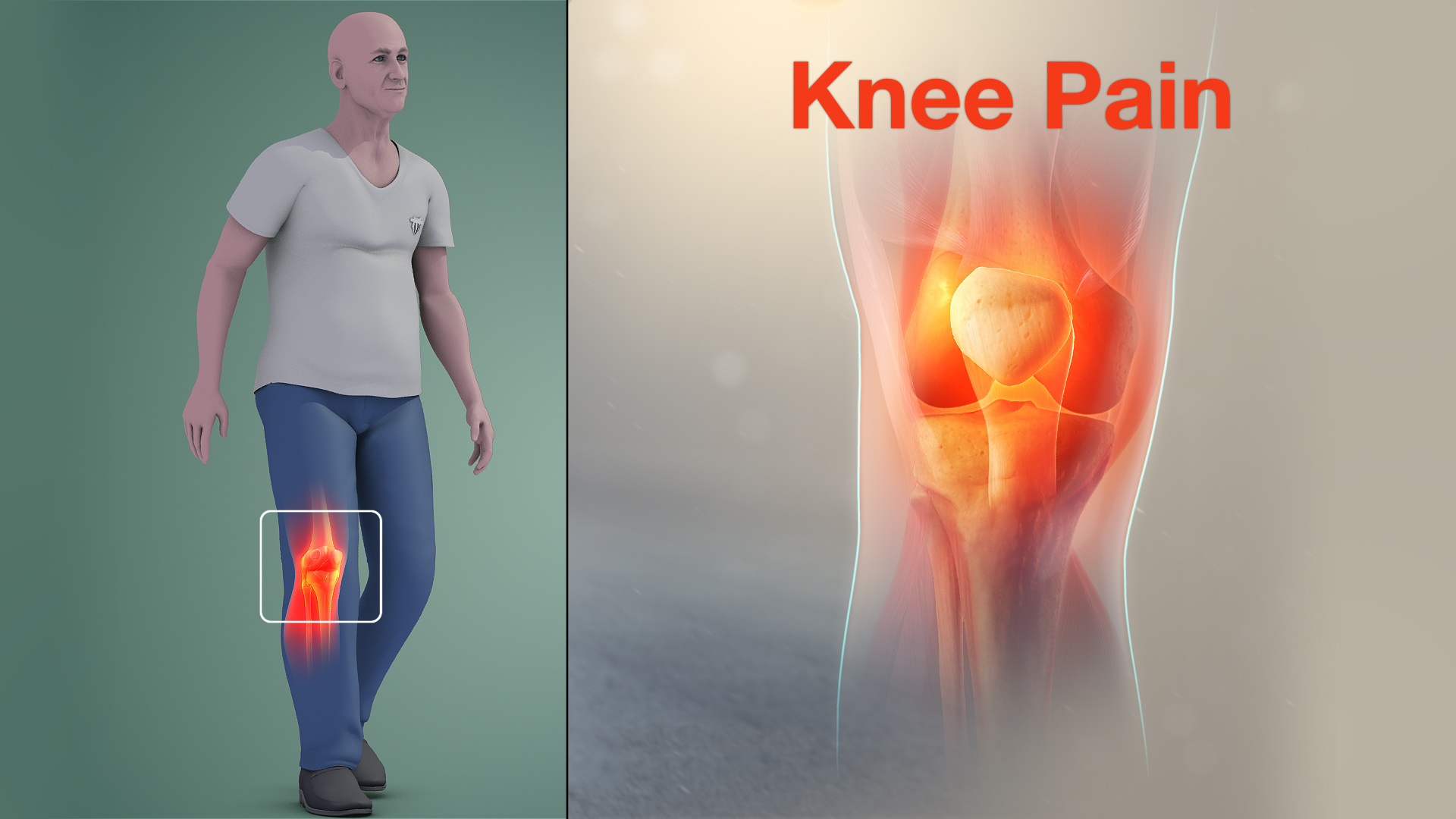 Medical animation still shot showing the damage in the knee joint that can cause knee pain