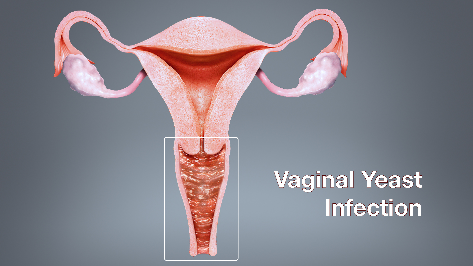 Medical Animation Still Shot Showing Vaginal Yeast Infection