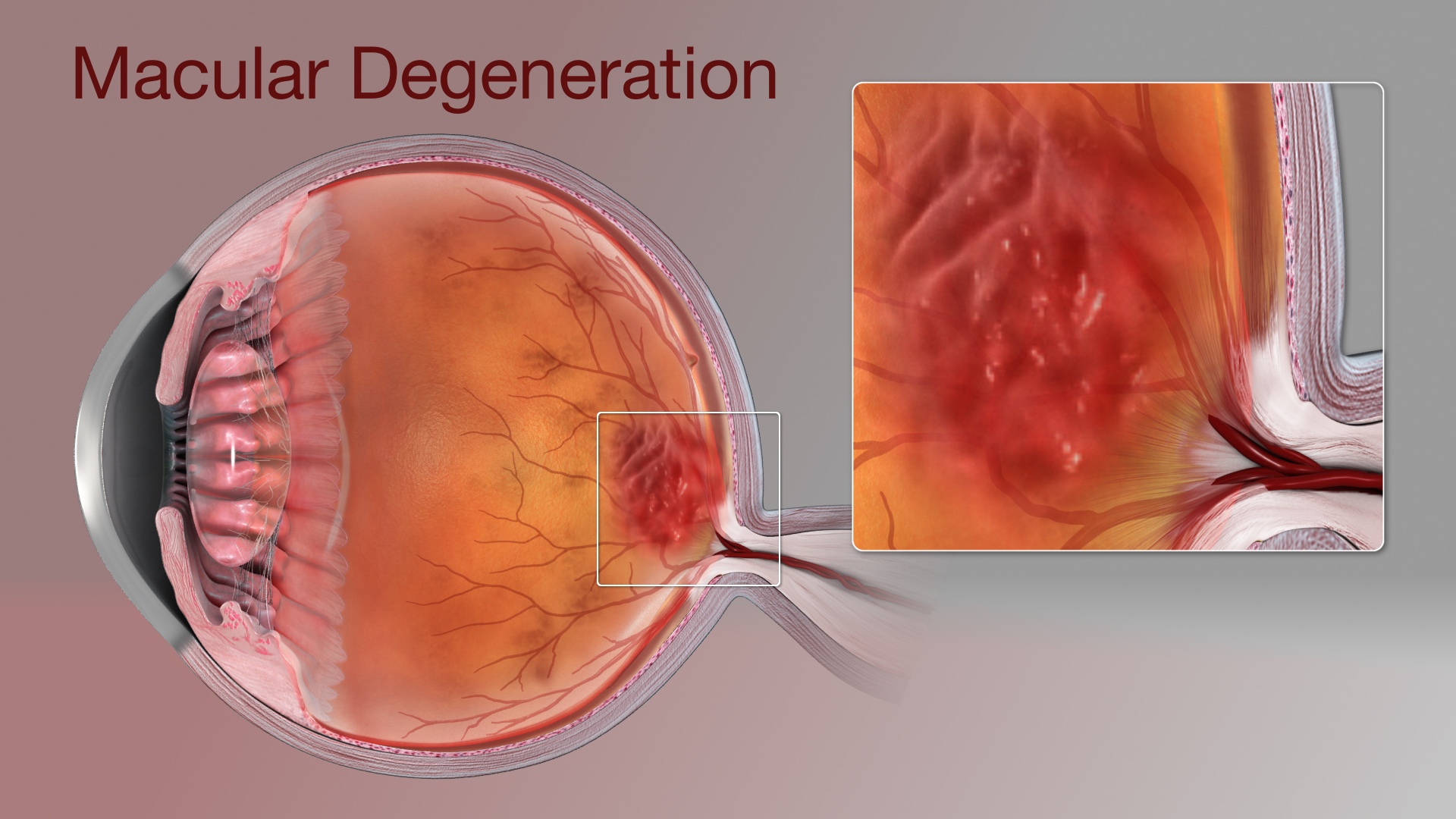 Medical animation still shot showing Macular Degeneration