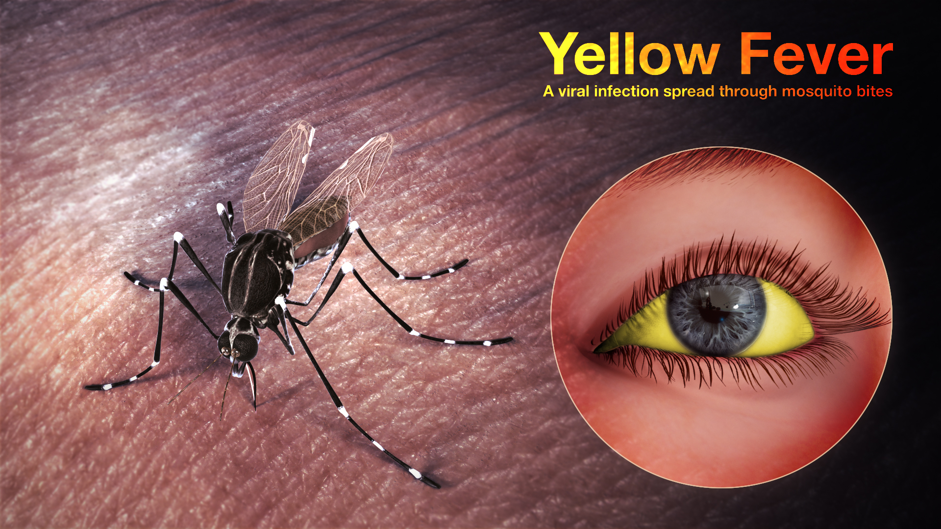 Yellow Fever Shown & Explained Using Medical Animation Still Shot