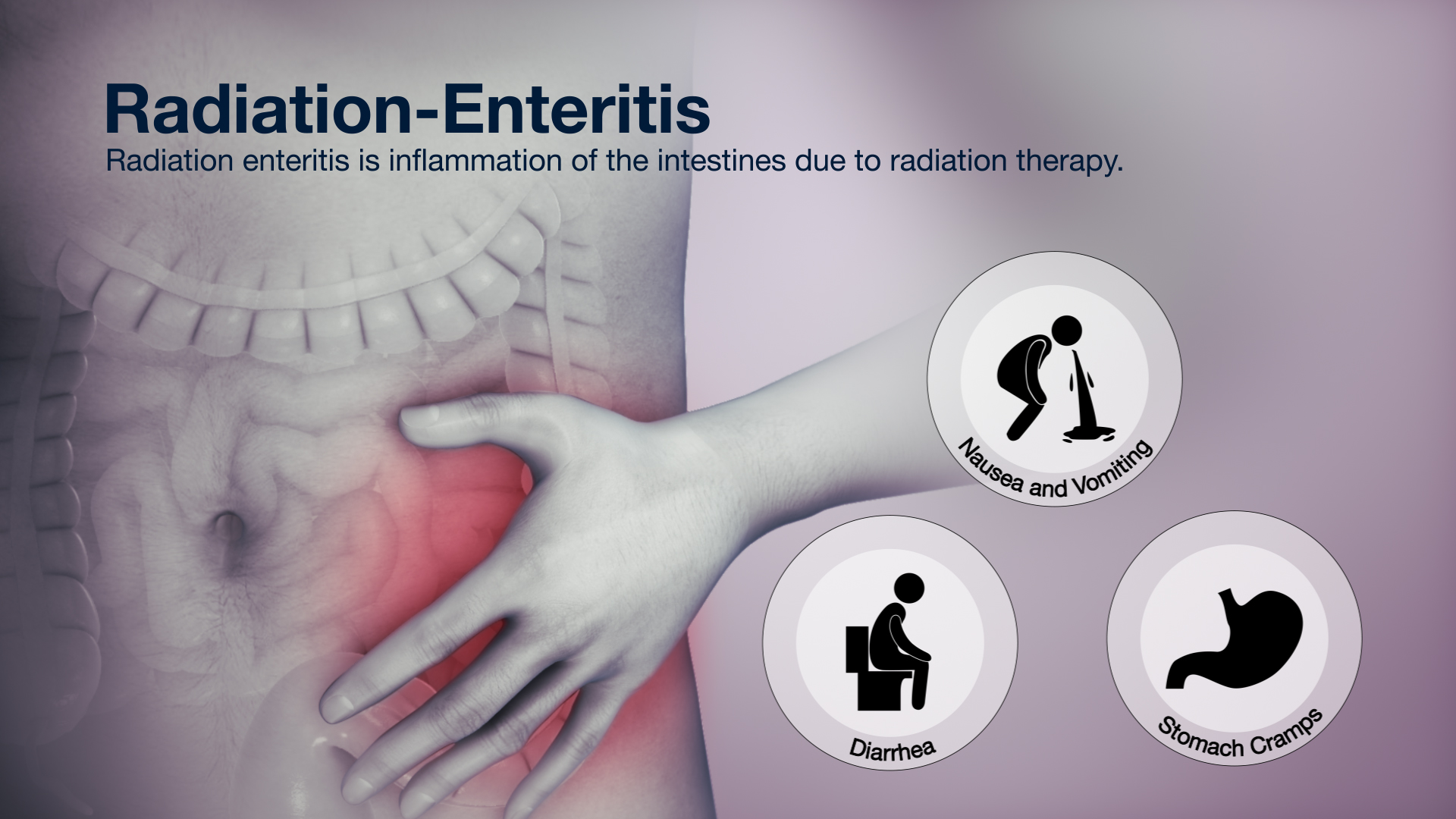 3D Medical Animation Showing Symptoms of Radiation Enteritis