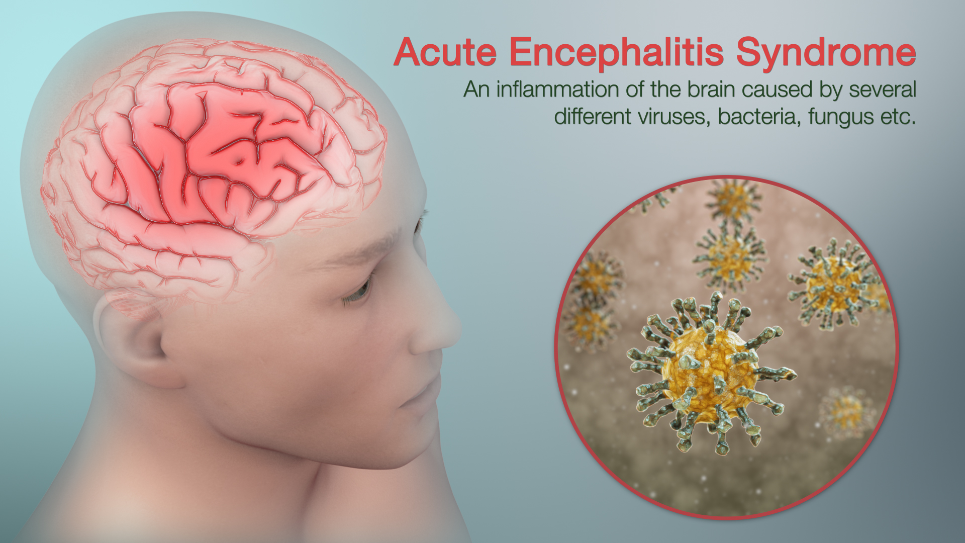 Acute Encephalitis Syndrome Shown Using Medical Animation