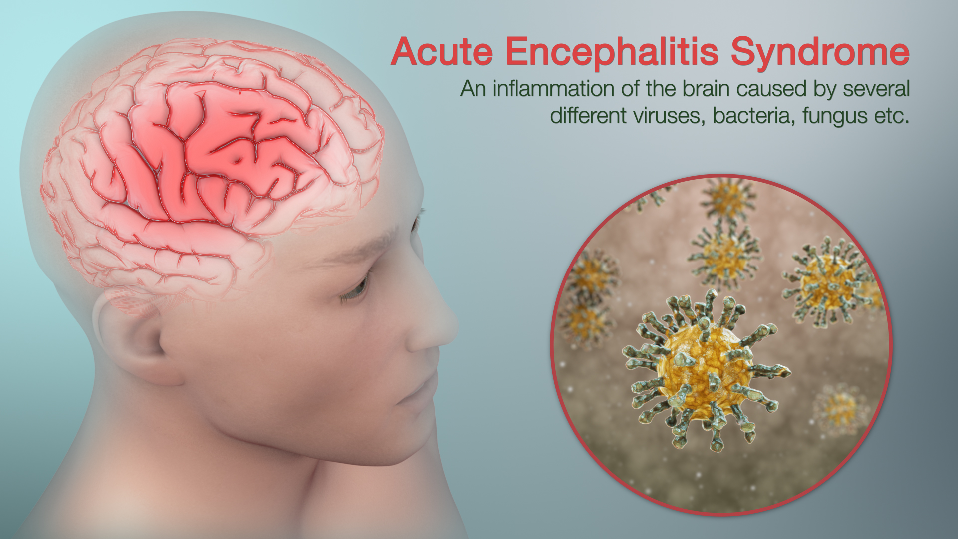 Medical Animation Showing Acute Encephalitis Syndrome