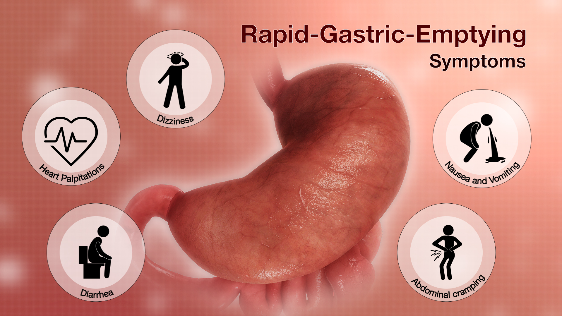 Medical Animation Showing Symptoms of Rapid Gastric Emptying