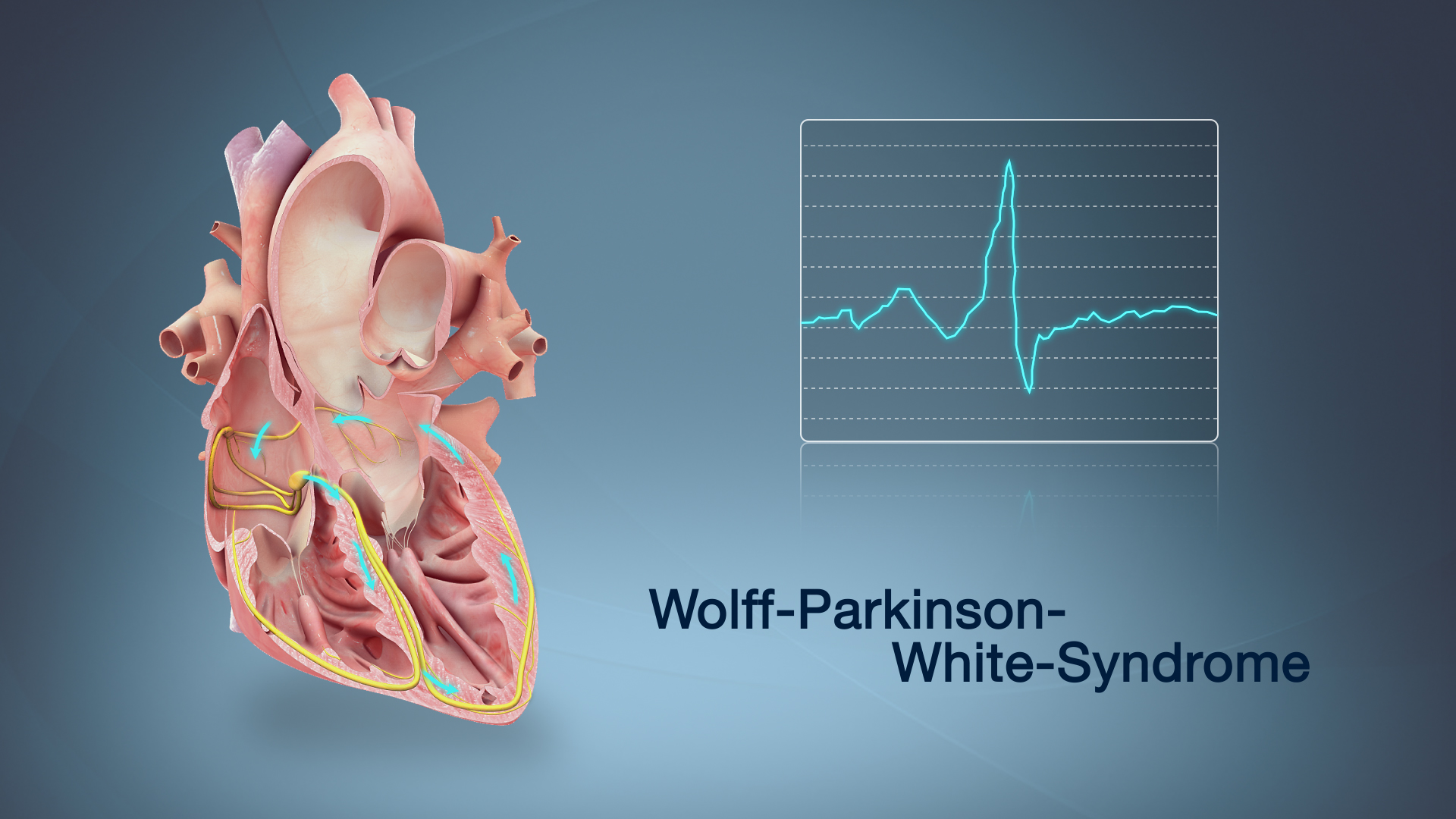 Medical Animation Showing Wolff-Parkinson-White Syndrome