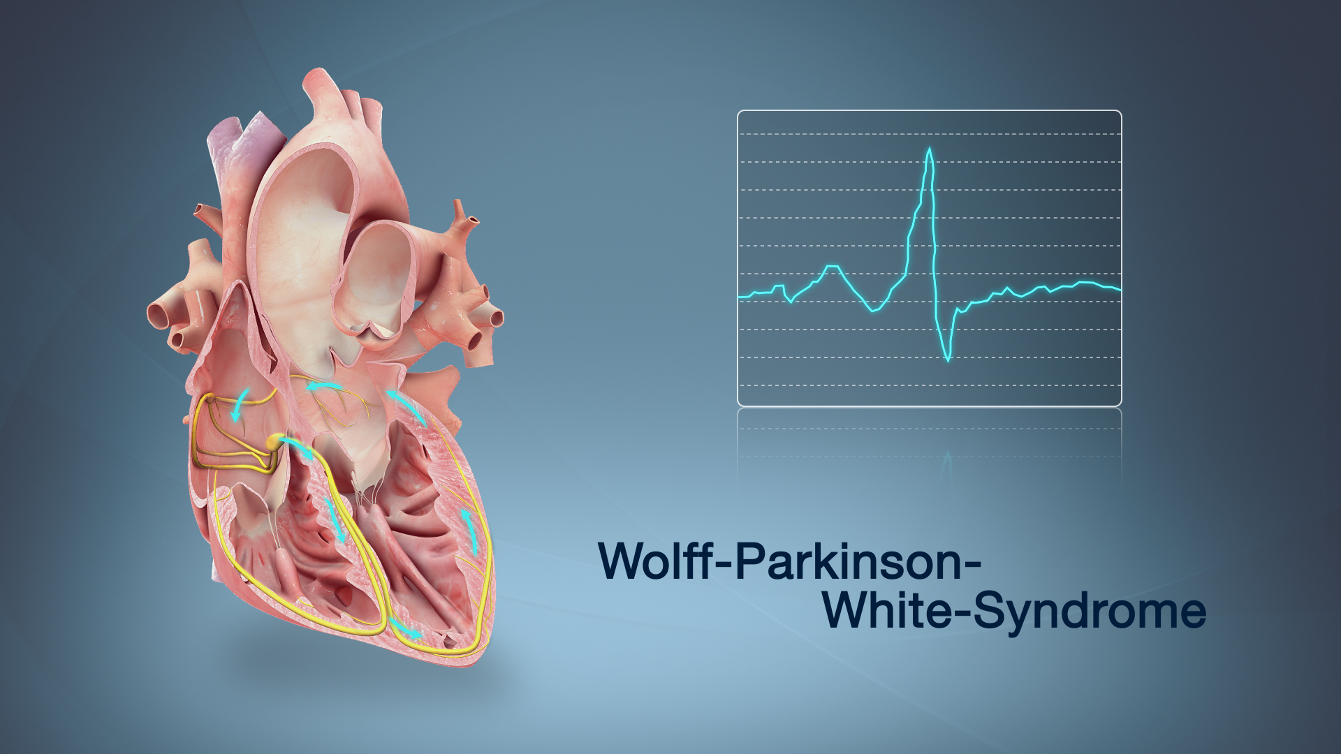 Síndrome De Wolff Parkinson White