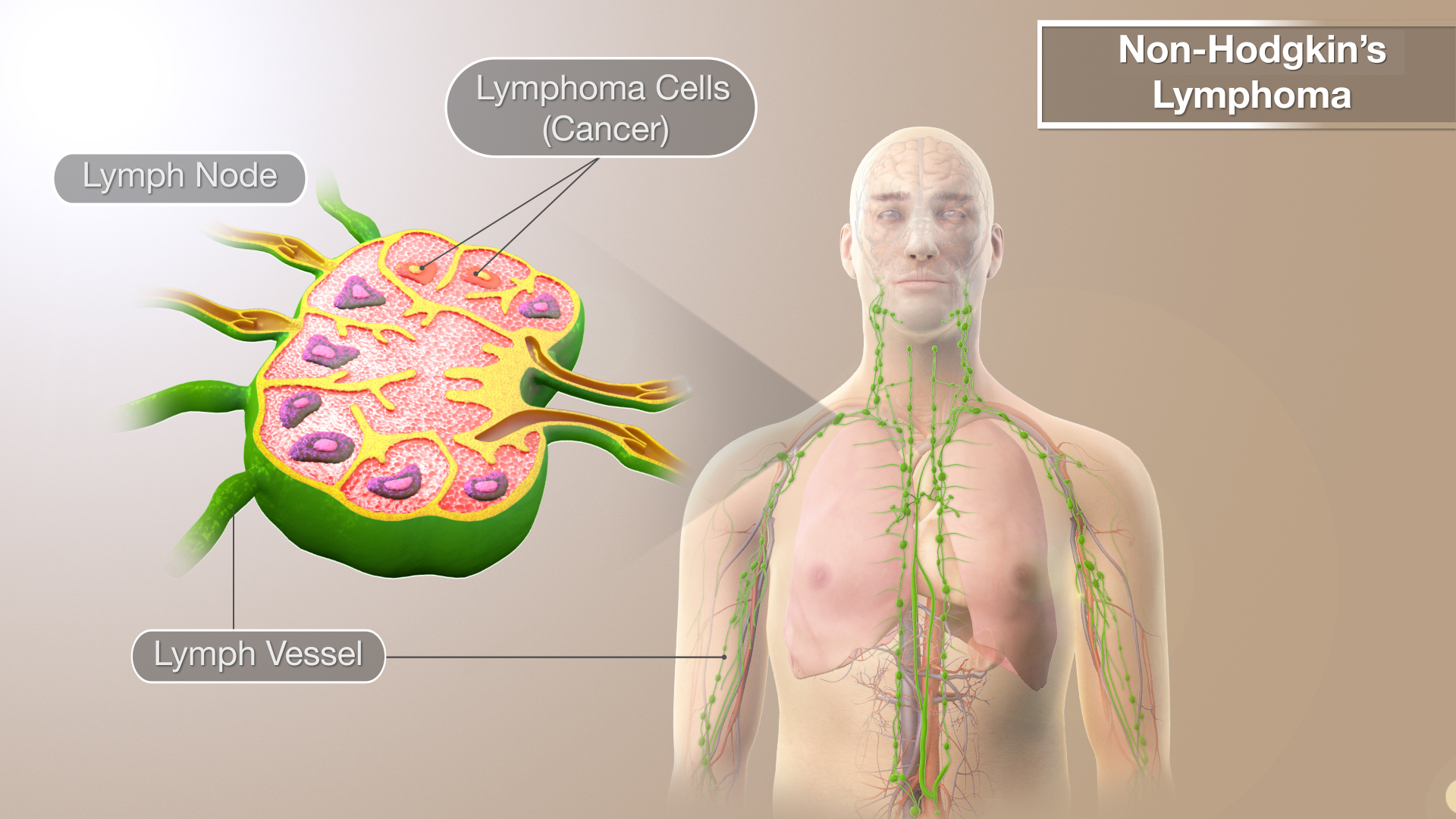 Medical Animation Still Shot Showing Non-Hodgkin's Lymphoma