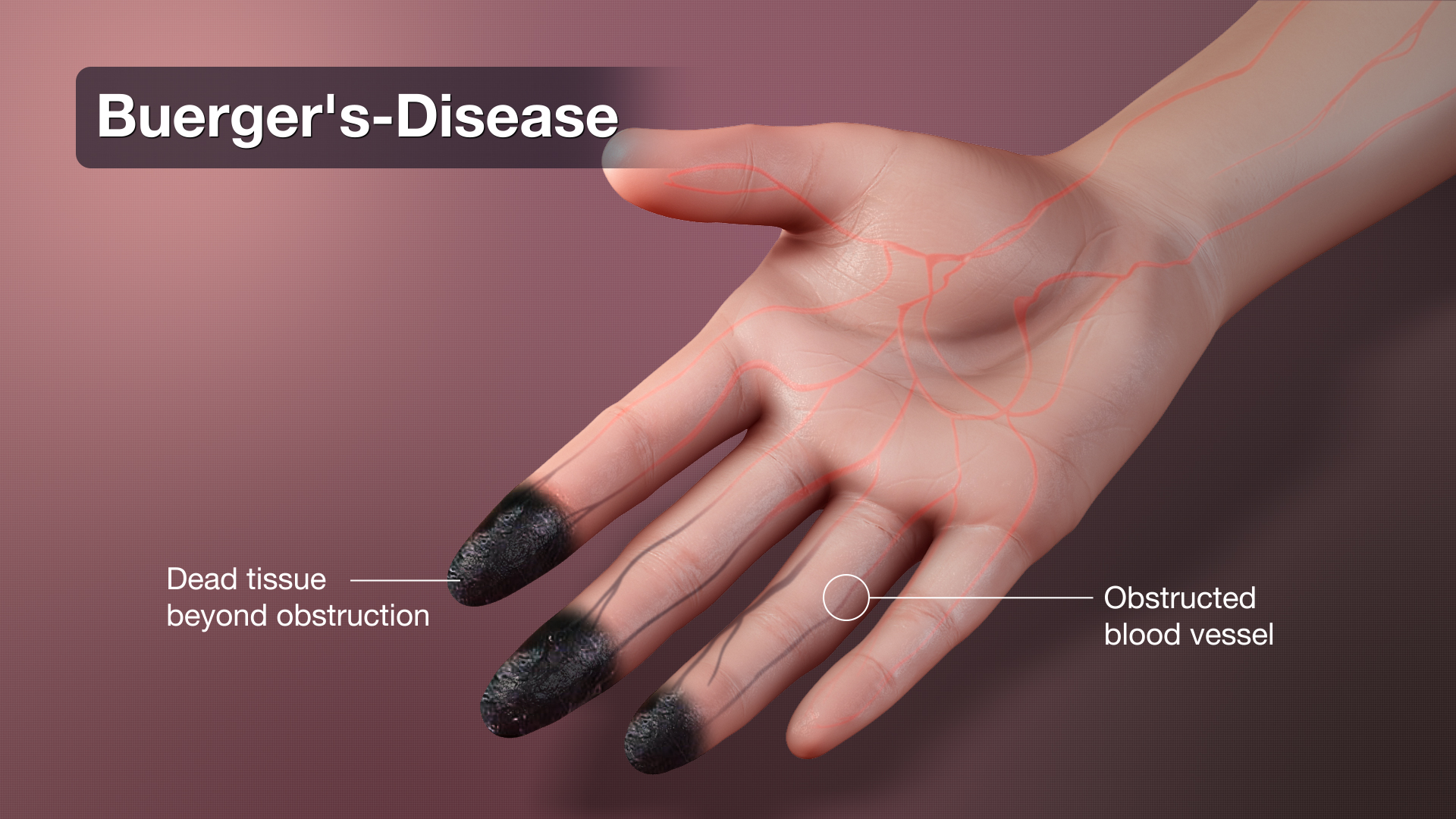  Buerger s Disease Shown Explained Using 3D Medical Animation