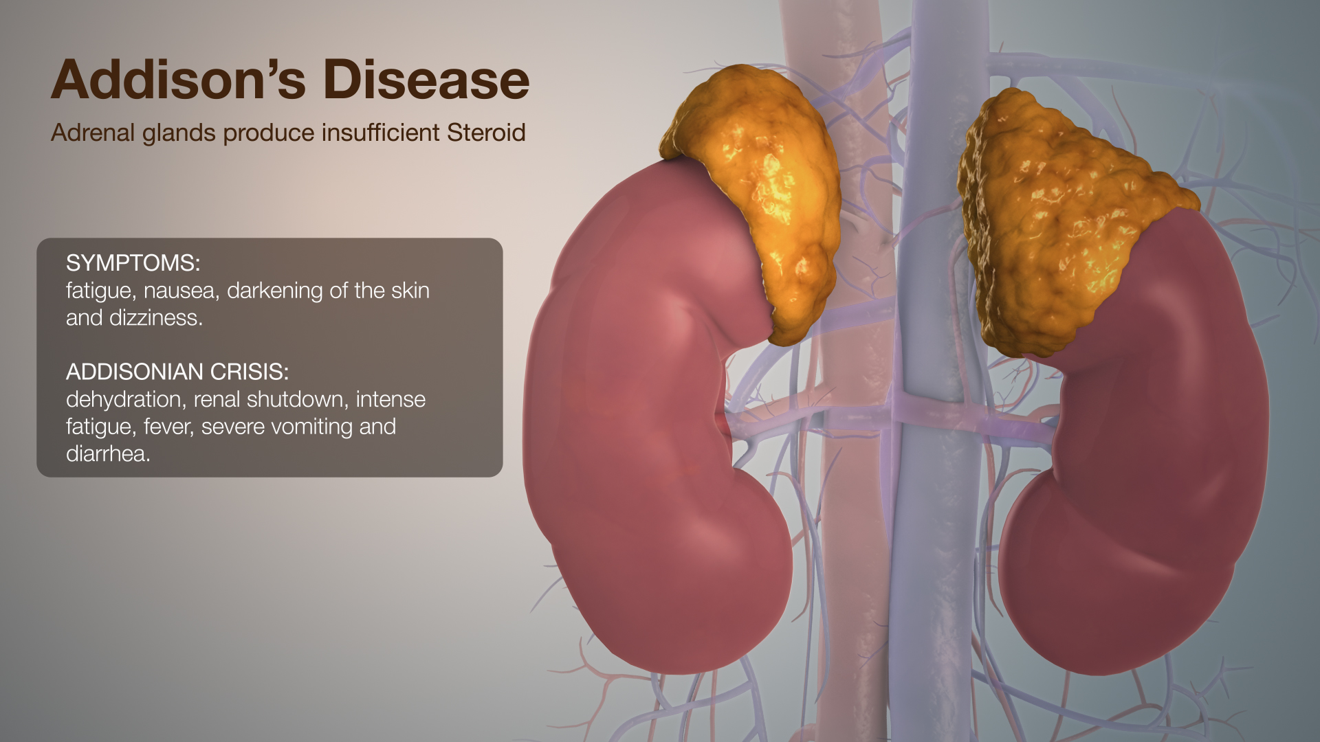 Medical Animation Explaining Addison's Disease