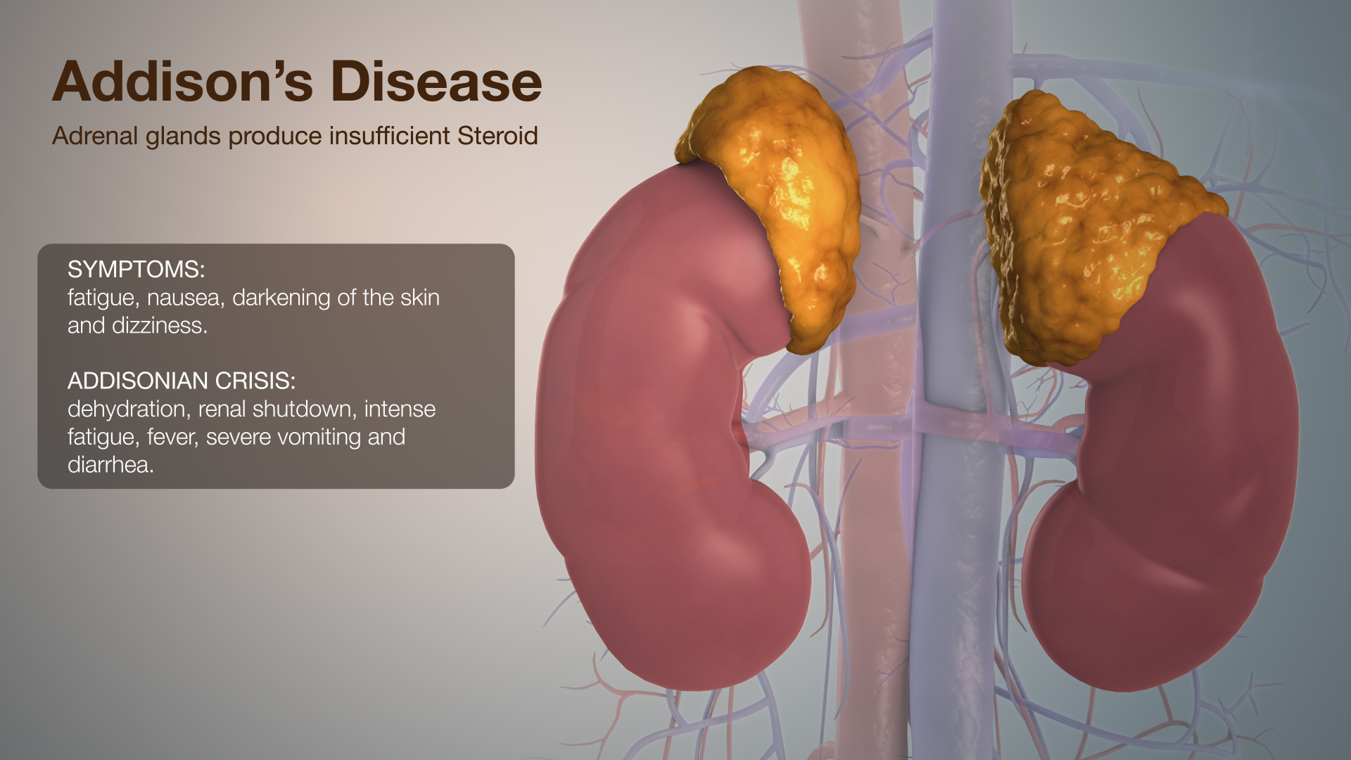 Addison s Disease Pacificjes