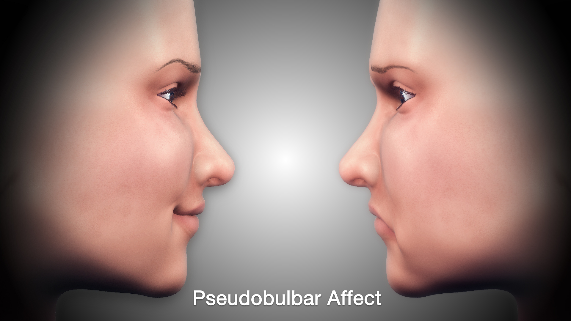 Medical Animation Illustrating Pseudobulbar Affect