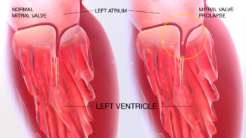 3D Medical Animation Mitral Valve Prolapse