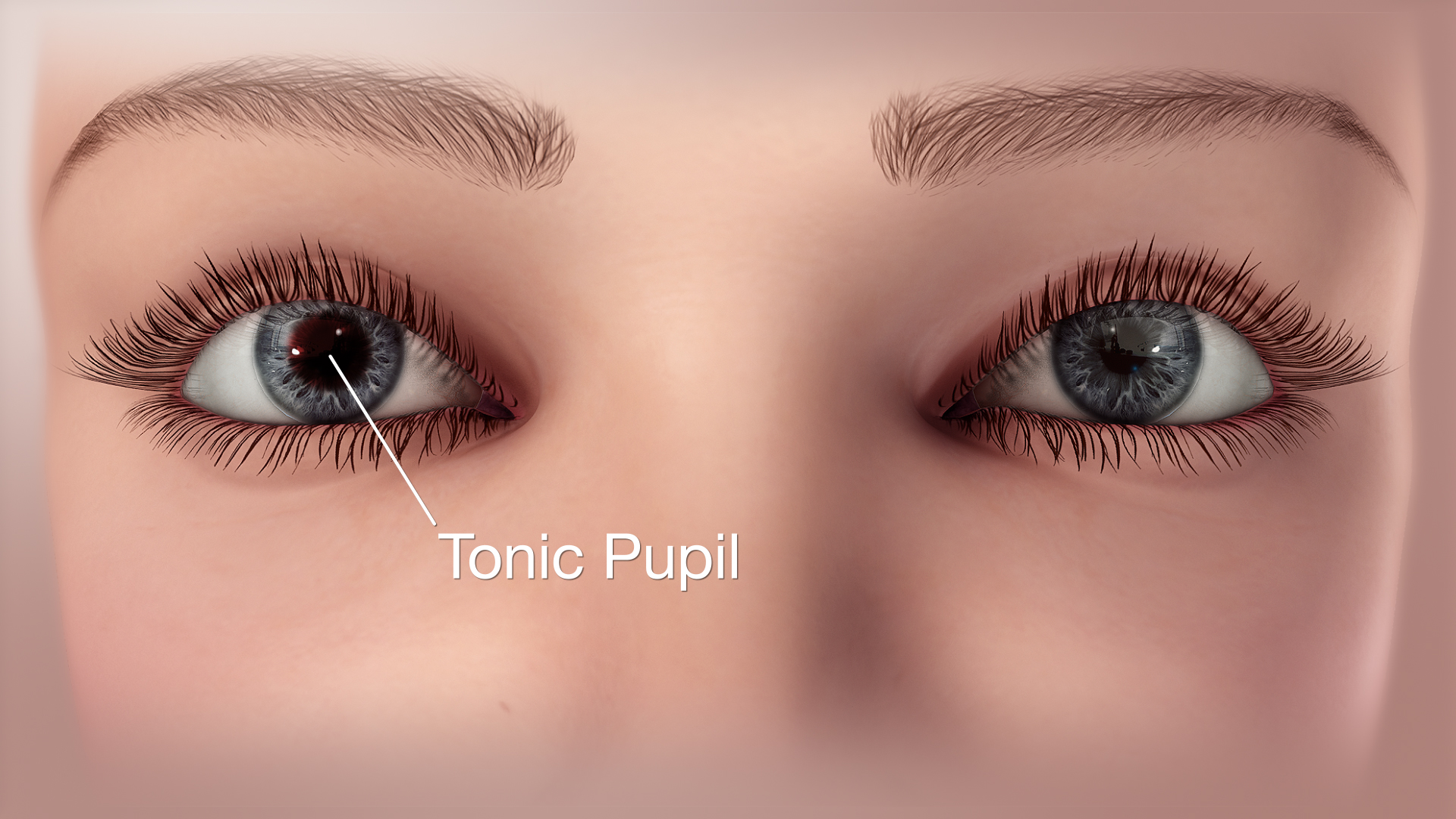 3D Medical Animation Showing Tonic Pupil Syndrome