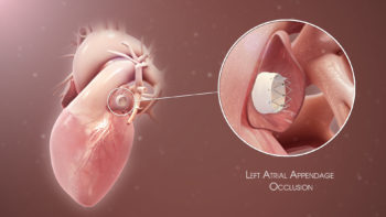 3D Medical Animation of Left Atrial Appendage Occlusion