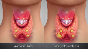 3D Medical Animation still shot Hyperparathyroidism