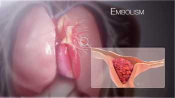 3D Medical Animation still shot Pulmonary Embolism