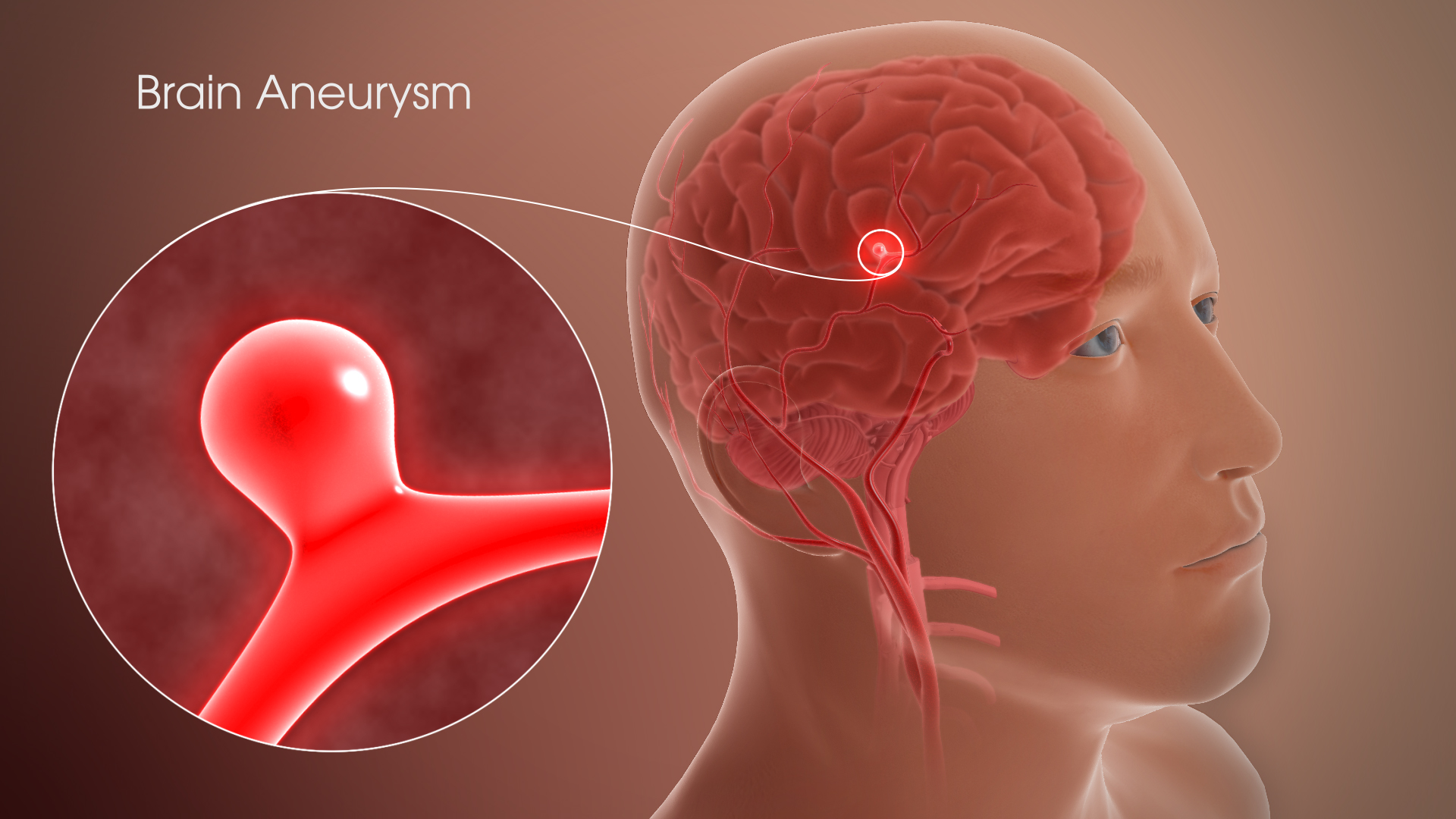 3D Medical Animation Still Shot Showing Brain Aneurysm