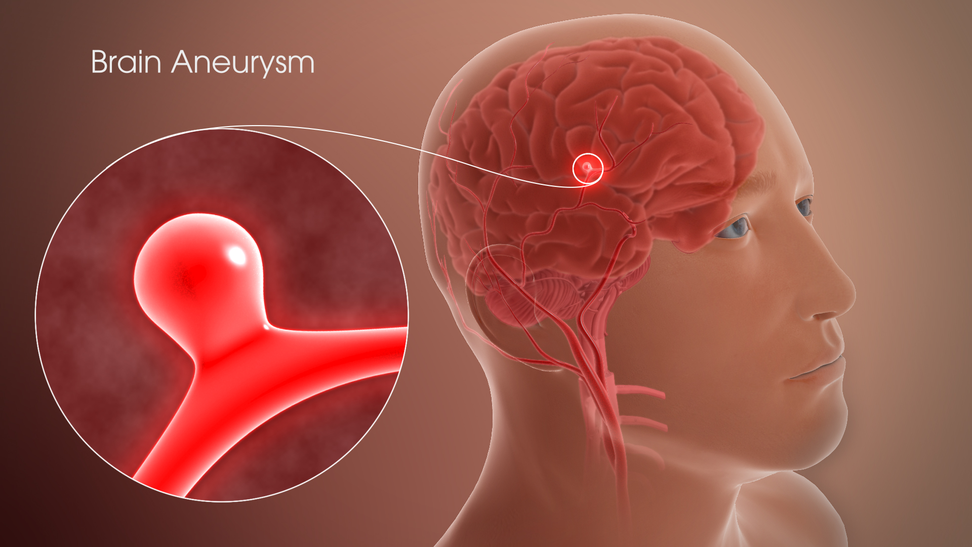 brain aneurysm magyarul