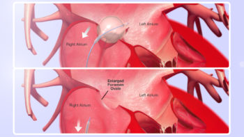 3D Medical Animation still shot Balloon Septostomy