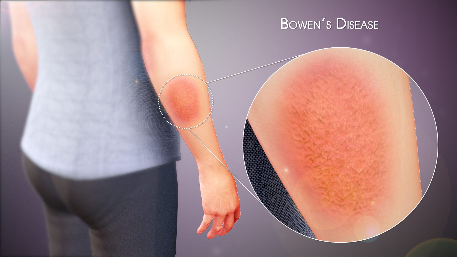 Medical Animation Still Shot Showing Bowen's Disease