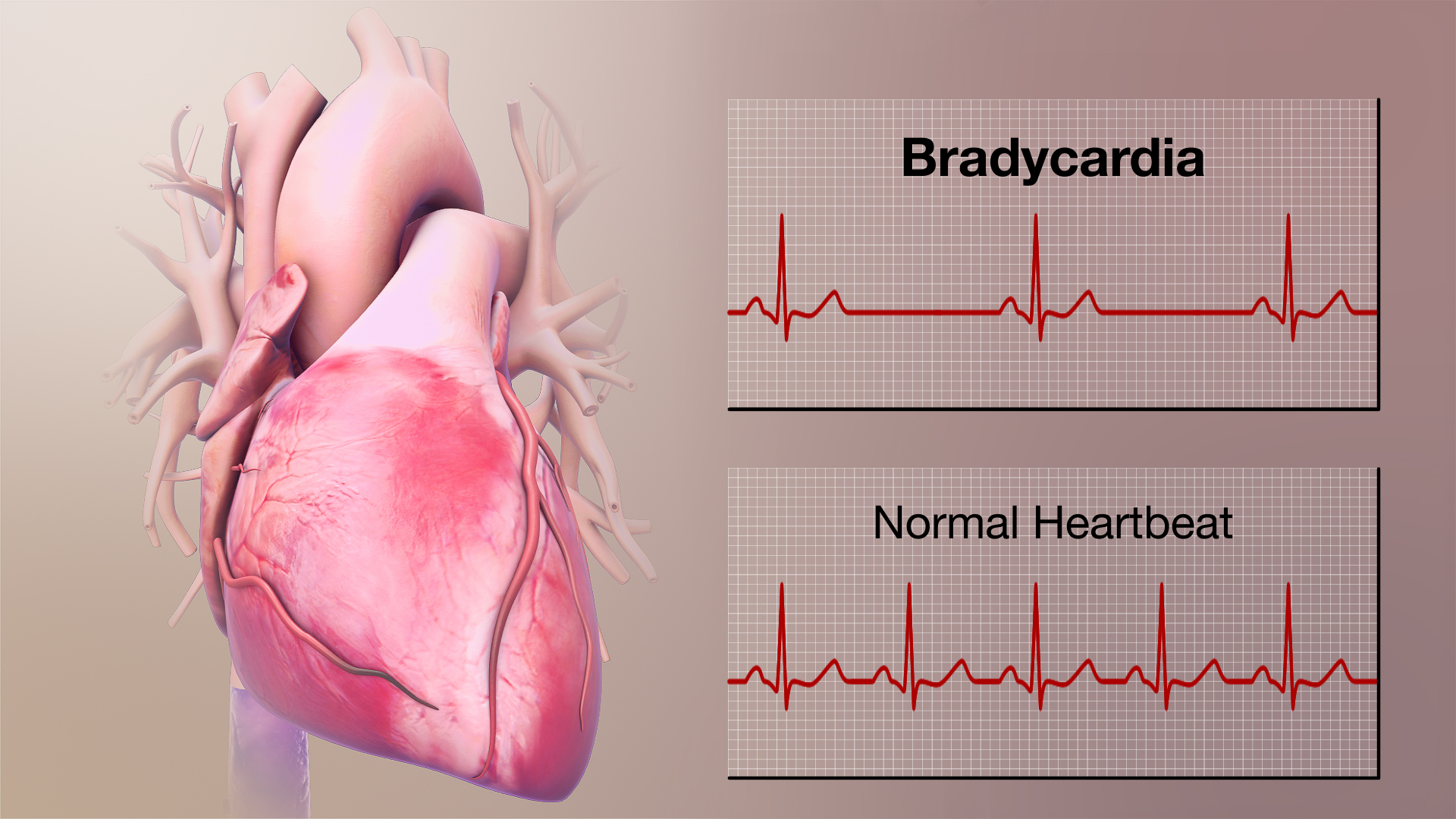 3D Medical Animation Depicting Bradycardia Vs. Normal Heartbeat