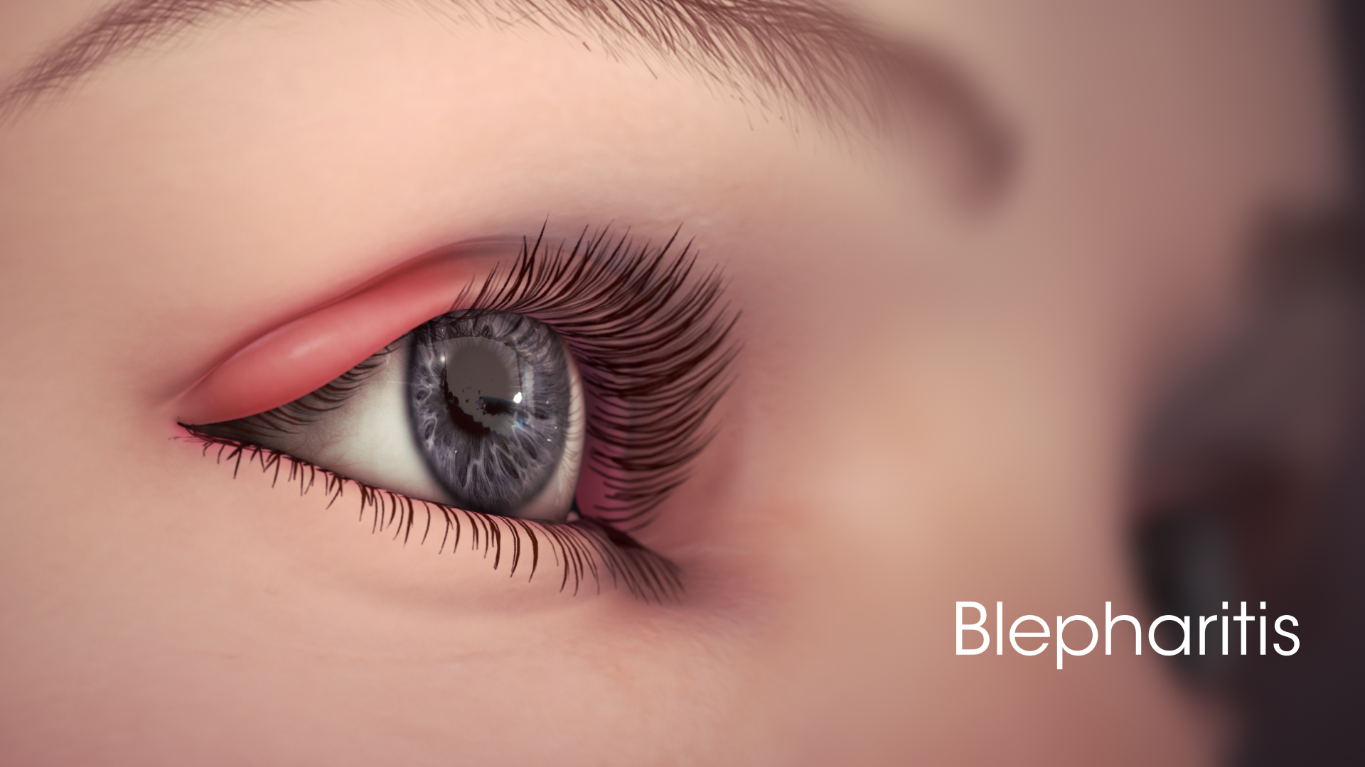 Medical Animation Illustrating Blepharitis