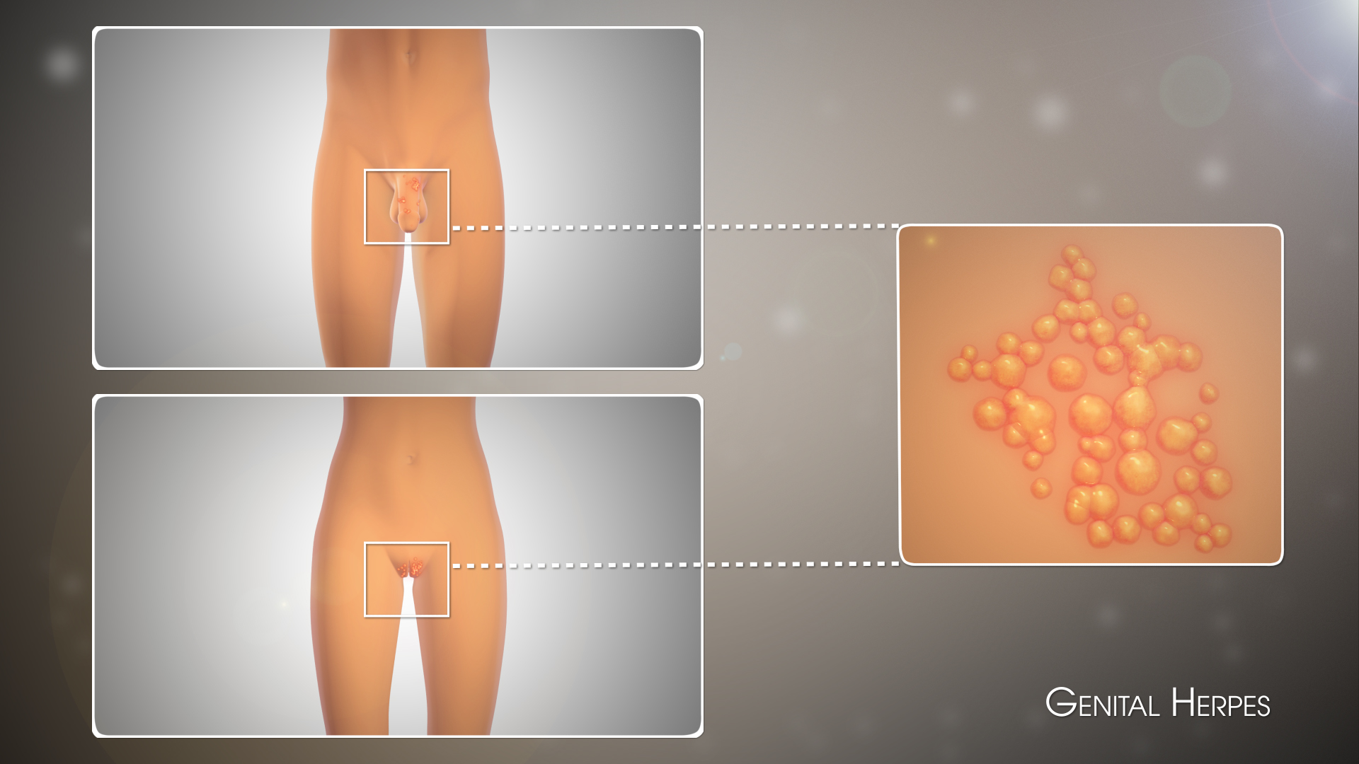 Medical Animation Still Shot Illustrating Genital Herpes