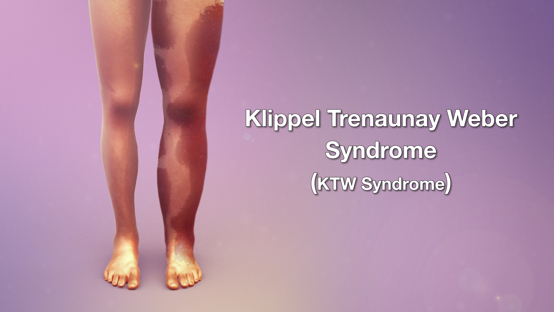 Medical Animation Illustrating Klippel-Trenaunay-Weber (KTW) syndrome
