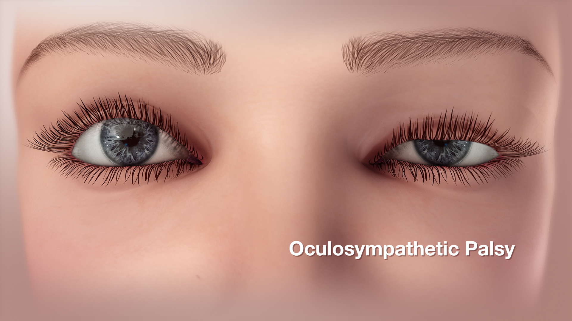 Medical Animation Illustrating Oculosympathetic Palsy