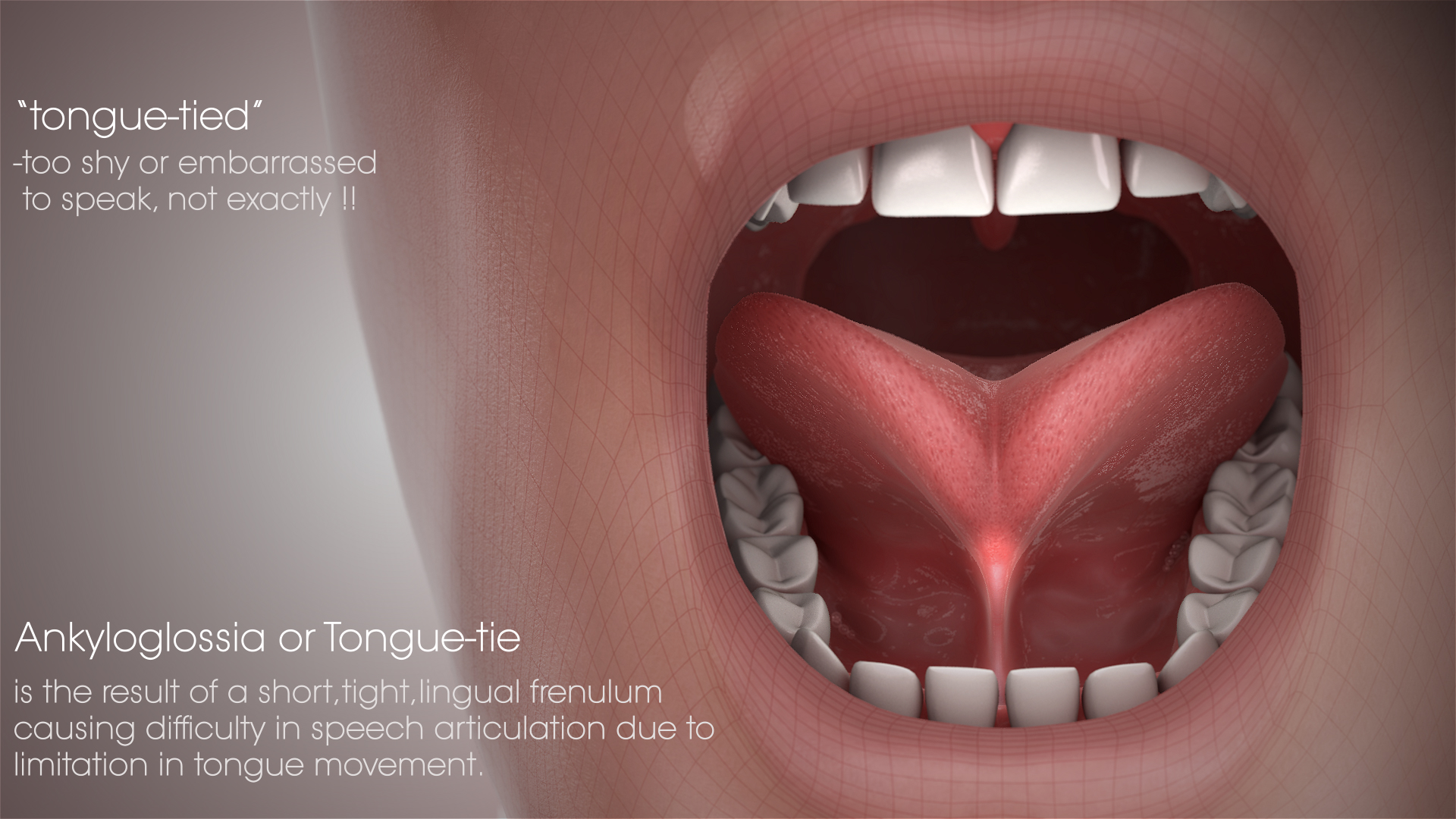 Tongue Tie Shown Explained Using A Medical Animation