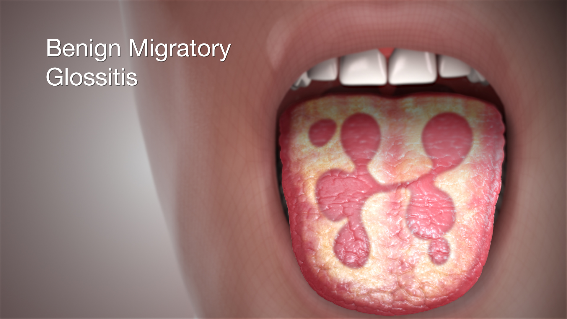 3D Medical Animation Illustrating Benign Migratory Glossitis