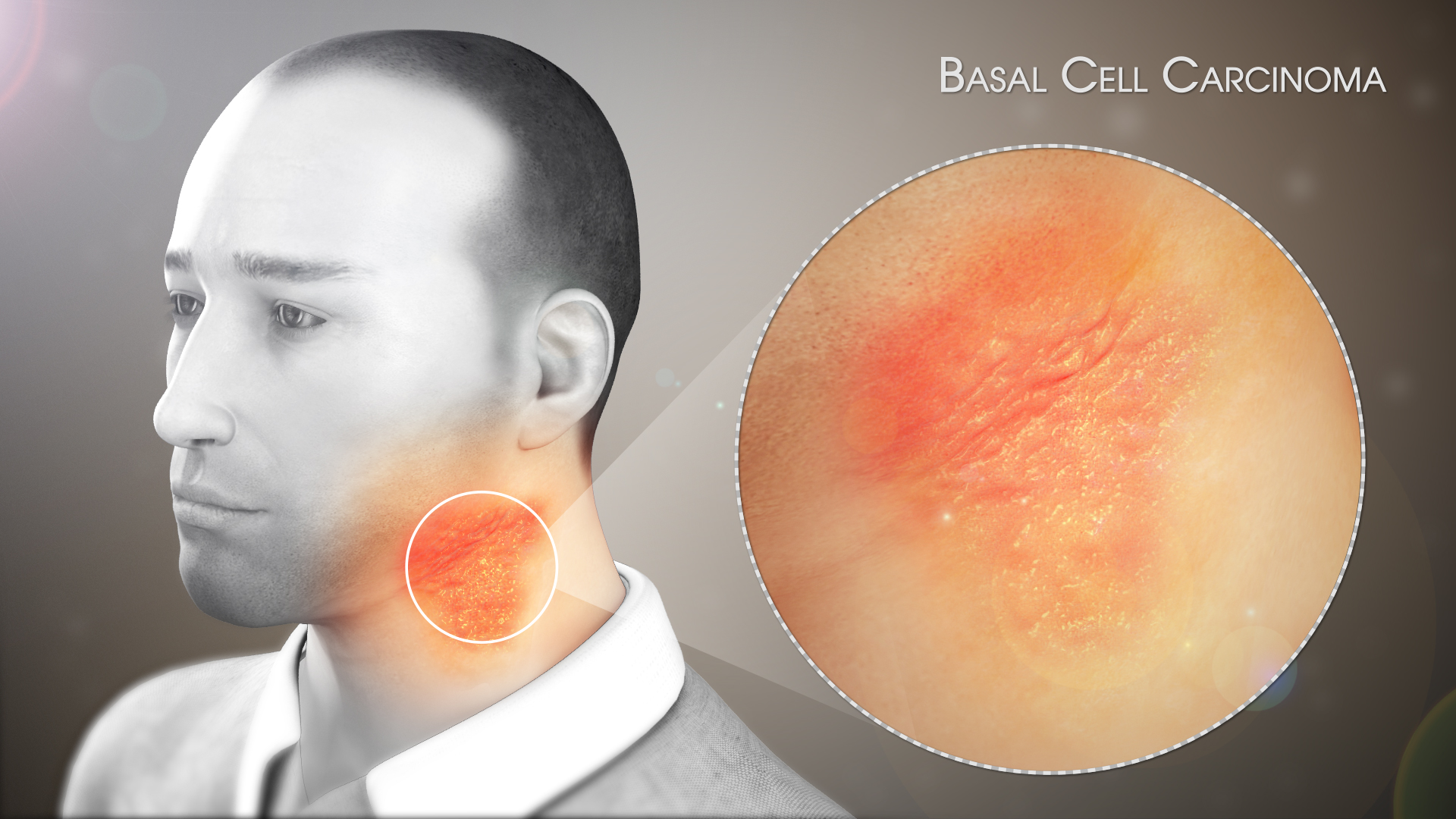 3D Medical Animation Still Shot Showing Basal Cell Carcinoma