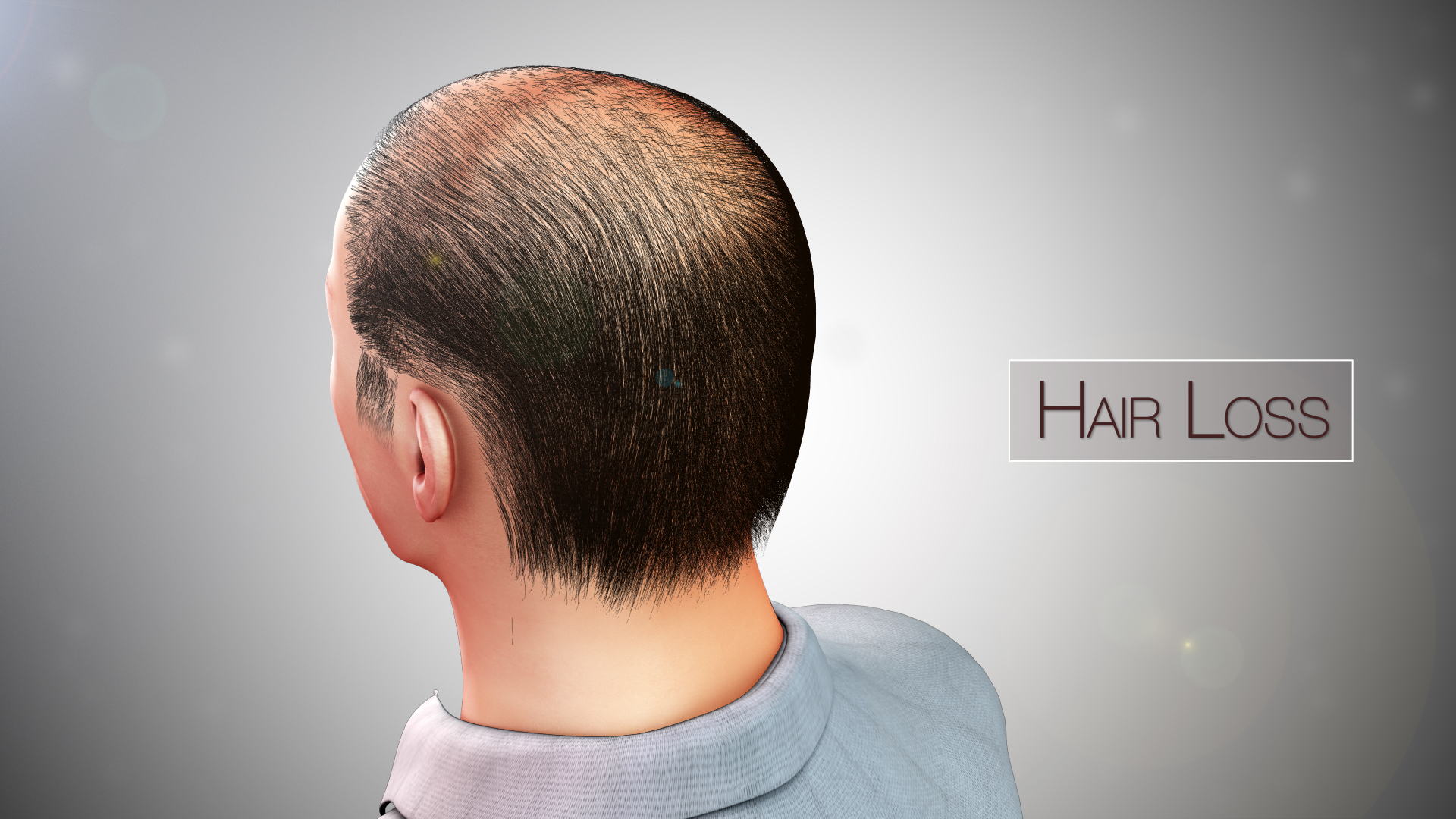 Medical Animation Showing Hair Loss